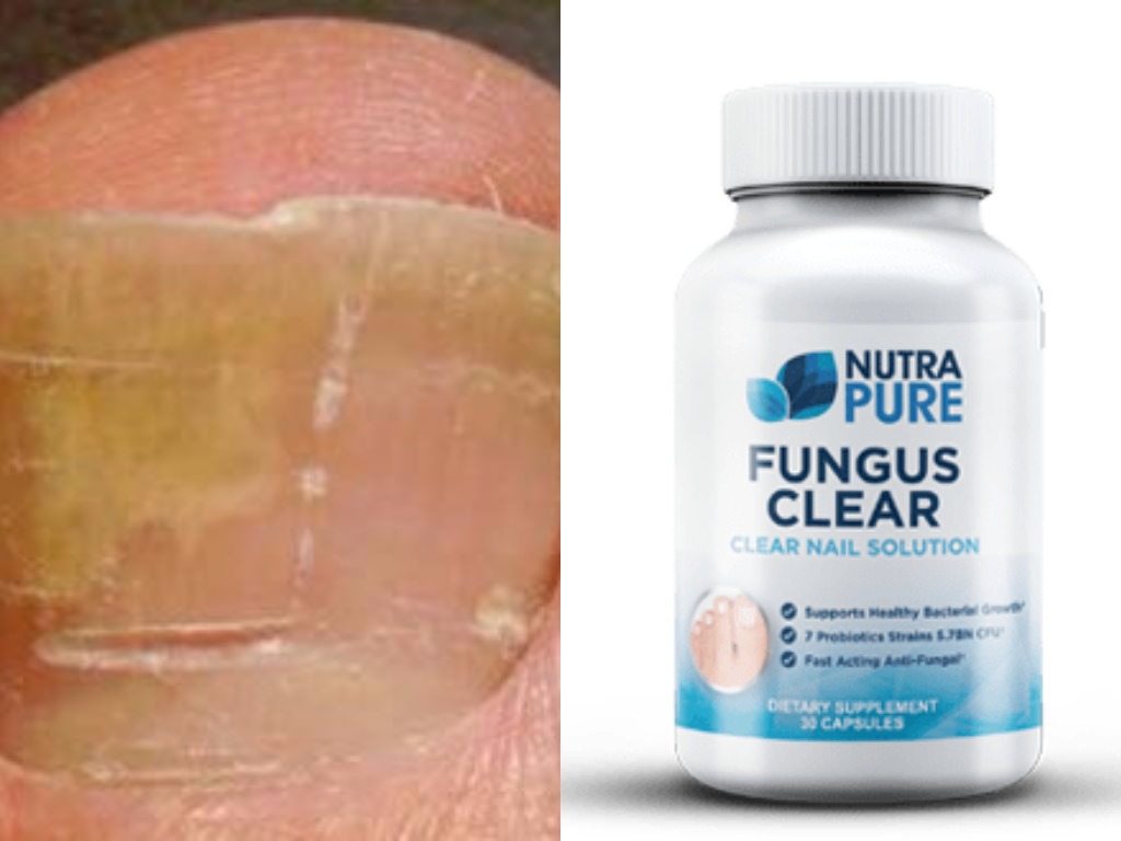 NutraPure Clear Fungus Review